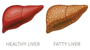 10 Foods That Can Help Reverse Fatty Liver Disease Naturally