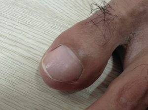 Toe Hair Loss: A Small Sign That May Reveal Big Health Issues — Doctors Explain What It Really Means