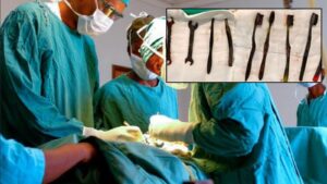 Seven Toothbrushes and Two Iron Sheets Found in Stomach During Shocking Surgery on Young Man, Doctors Stunned