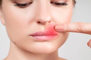 Winter Mouth Ulcers: Why Cold, Dry Weather Triggers Painful Sores And How To Prevent Them