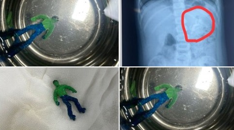 1.5 Year Old's X-ray Shows Hulk Toy in Stomach: Doctors Remove Entire Toy From Toddler’s Stomach, Child Safe