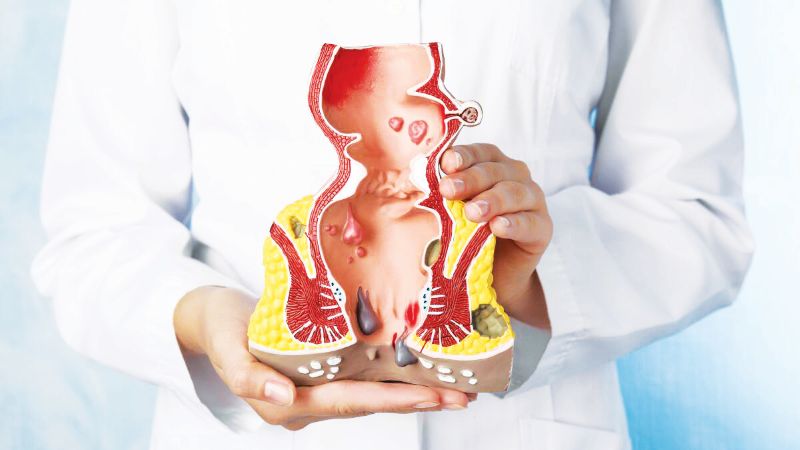 What You Need To Know AboutAnal Fistula And Its Treatment-Ask The Expert