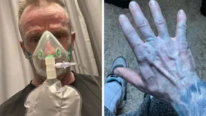 UK Man Wakes Up With Blue Skin, The Real Cause Leaves Doctors Amused