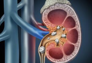 Summer Heat and Your Health: Understanding the Rise in Kidney Stones and UTIs